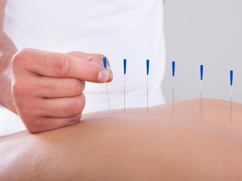 Acupunctuur