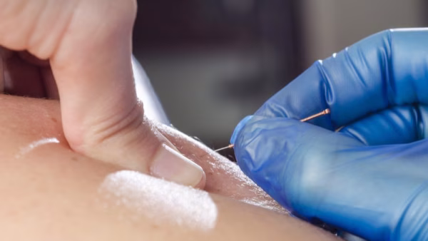Dry needling