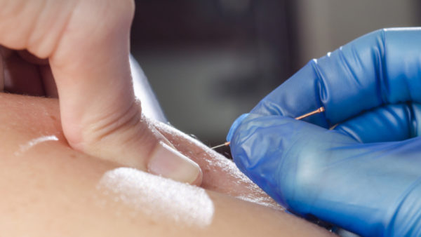 Dry needling